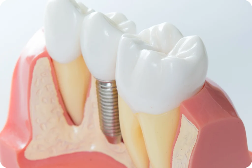 Implant dentaire