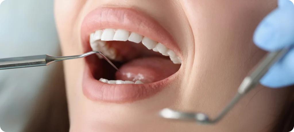 Contrôle des dents avant éclaircissement, dentiste à Strasbourg