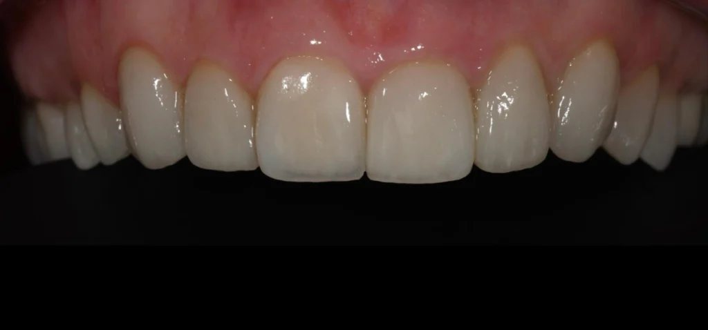 Gros plan sur des dents restaurées par facettes dentaires, dentiste à Strasbourg